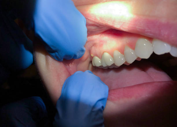 Best Tooth Infection Emergency Dentist  in Patterson, LA